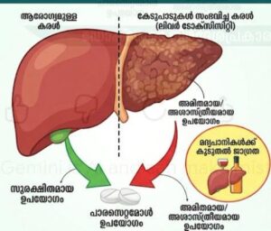 ശാസ്ത്രീയമായി ഉപയോഗിച്ചില്ലെങ്കിൽ പാരസെറ്റമോൾ കരളിനെ അപകടപ്പെടുത്തുംകൂടുതൽ സൂക്ഷിക്കേണ്ടത് മദ്യപാനികൾ ?